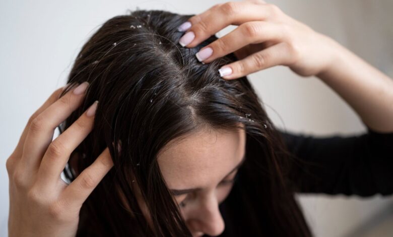 علت شوره سر و راهکارهای گیاهی برای درمان آن