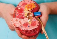 قبل از اینکه سنگ کلیه غافلگیرتان کند، ببینید جزو افراد پرخطر هستید یا نه!