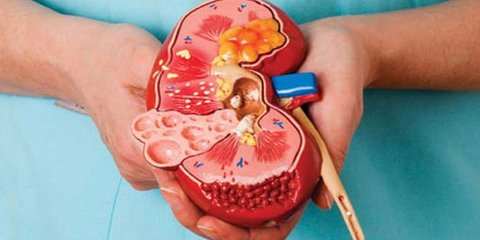 قبل از اینکه سنگ کلیه غافلگیرتان کند، ببینید جزو افراد پرخطر هستید یا نه!