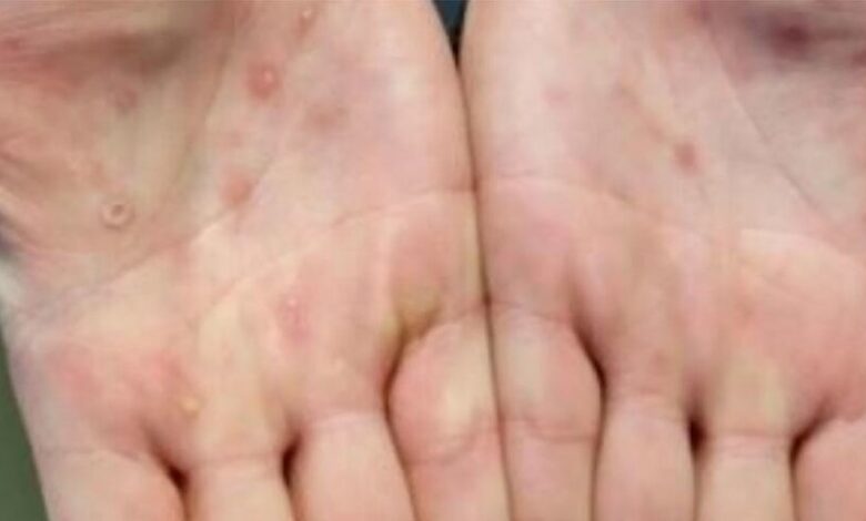 شیوع فصلی آبله‌مرغان؛ شروع از زمستان تا اوج در بهار