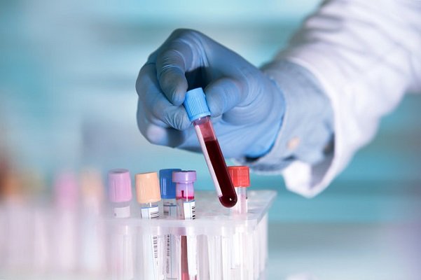 تاثیر آزمایش خون مبتنی بر DNA در درمان سرطان گلو - خبرگزاری مهر ایران و جهان