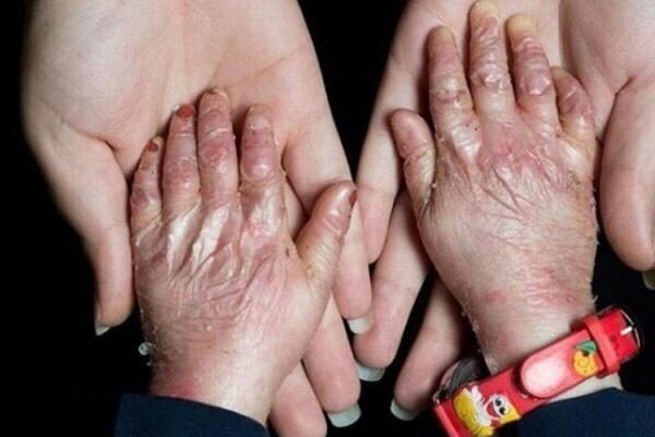 افزودن ۲۵ بیماری جدید به فهرست بیماریهای نادر