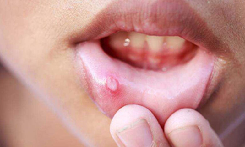 اثر مثبت نانوالیاف حاوی عصاره گلنار در ترمیم آفت دهانی