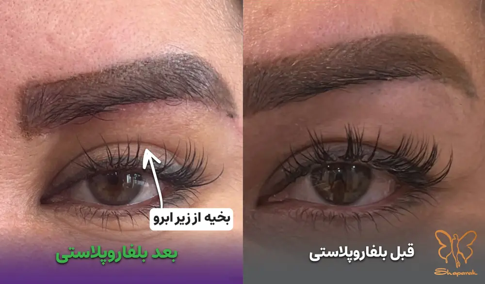 عکس قبل و بعد از بلفاروپلاستی در مشهد