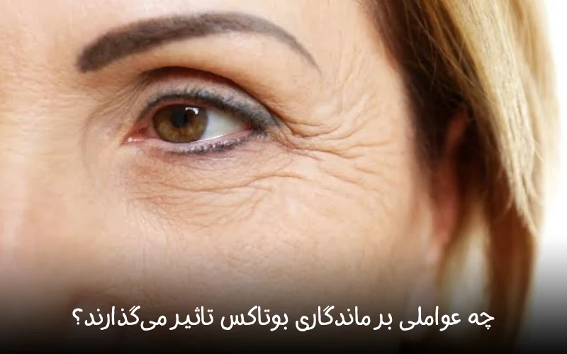 ماندگاری بوتاکس پیشانی و دور چشم