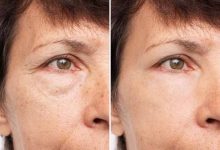 راهنمای کامل تزریق فیلر زیر چشم؛ هر آنچه قبل از تزریق باید بدانید