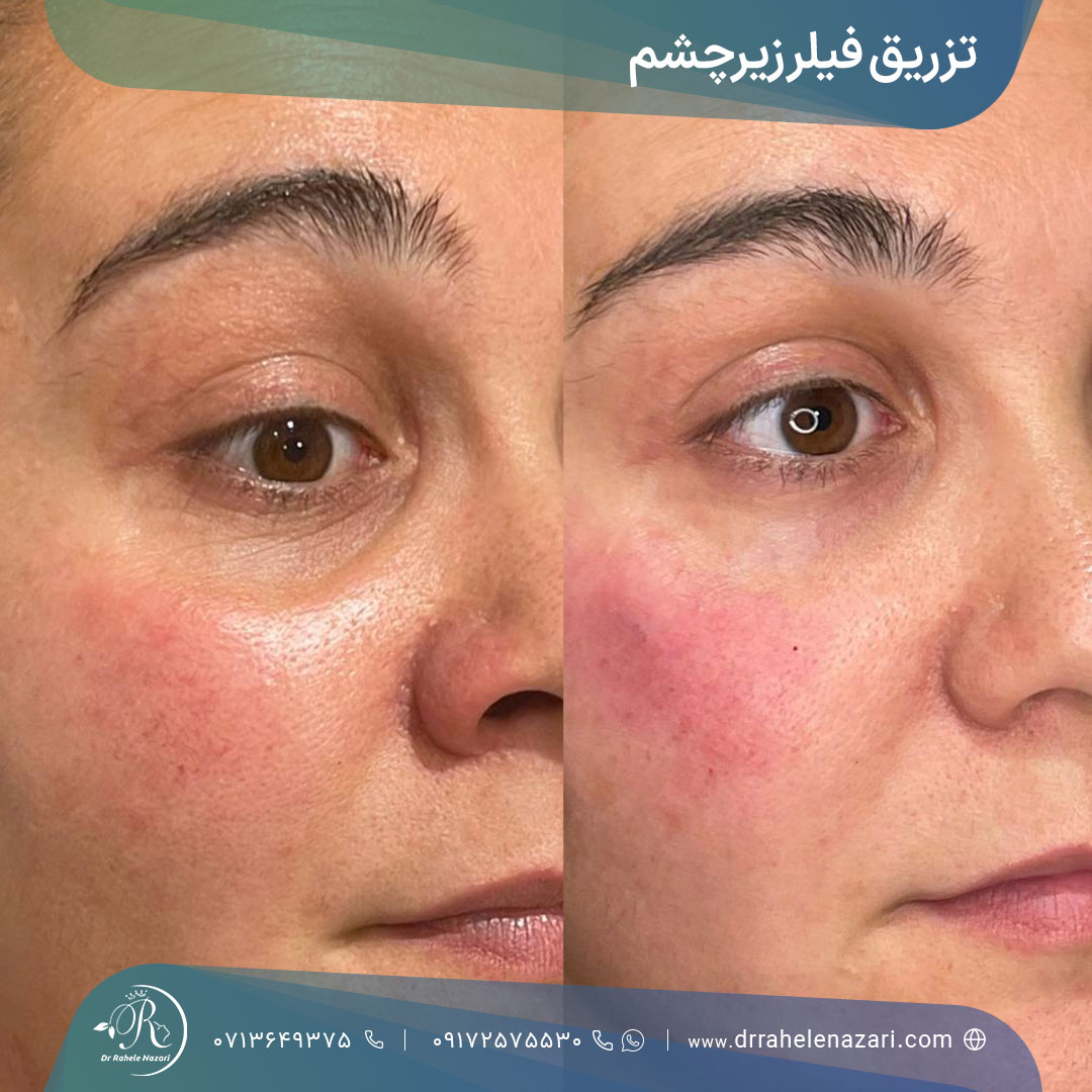 نتیجه فیلر زیرچشم