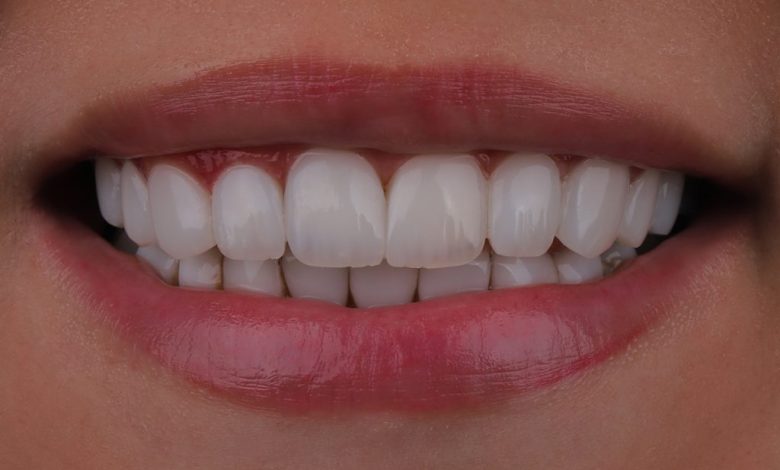 لمینت یا کامپوزیت؟ راهنمای جامع انتخاب بهترین روش اصلاح طرح لبخند