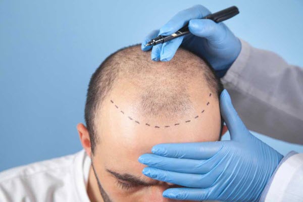 تجربه کاشت مو بدون بازگشت و درد در مجهزترین کلینیک زیبایی اصفهان