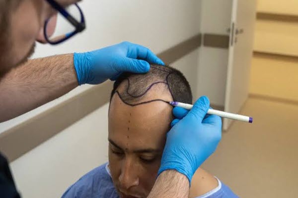 کاشت مو در اصفهان کلینیک بینتا