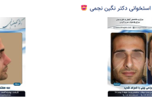 جراحی بینی قوز دار و استخوانی