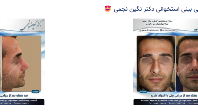 جراحی بینی قوز دار و استخوانی