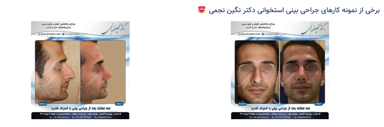 جراحی بینی قوز دار و استخوانی